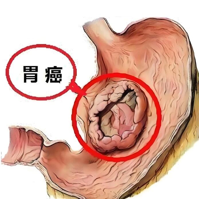 纠正3个坏习惯，远离胃癌困扰